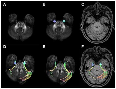 Trigeminal Nerve White Matter Fiber Abnormalities in Primary Trigeminal Neuralgia: A Diffusion Spectrum Imaging Study